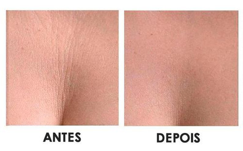 ADESIVOS ANTI SINAIS REUTILIZÁVEIS | SILICONE PADS + BRINDE EXCLUSIVO